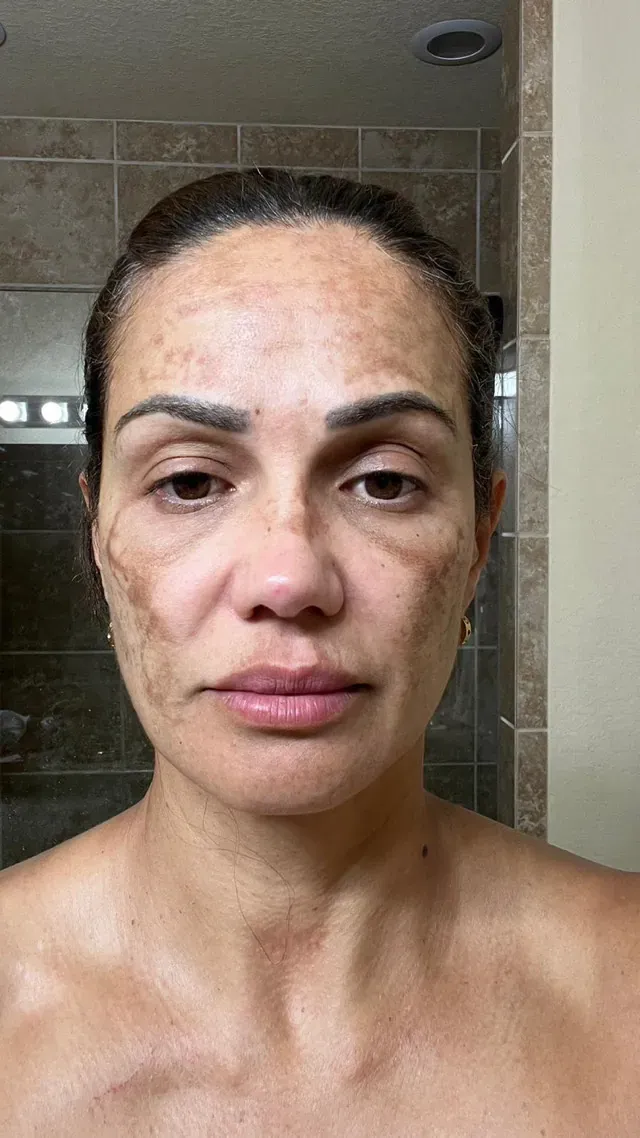 Sandra — day 0
