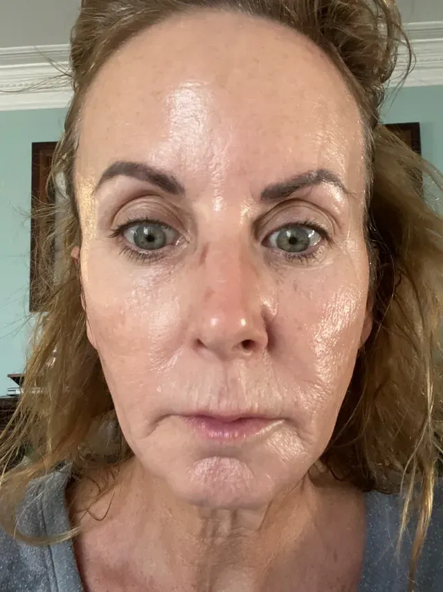 Denise R. before